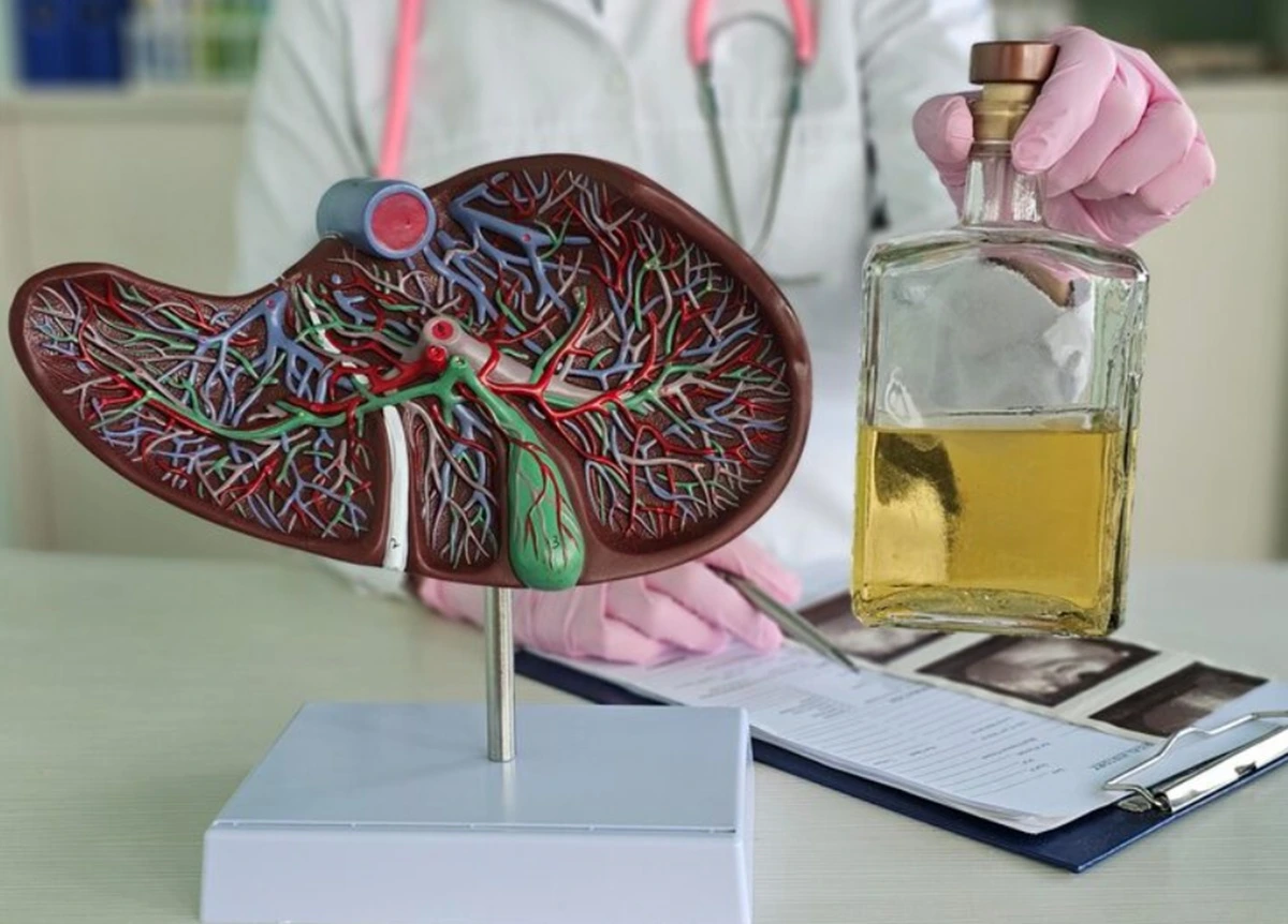 Ilustrasi fatty liver atau perlemakan hati.