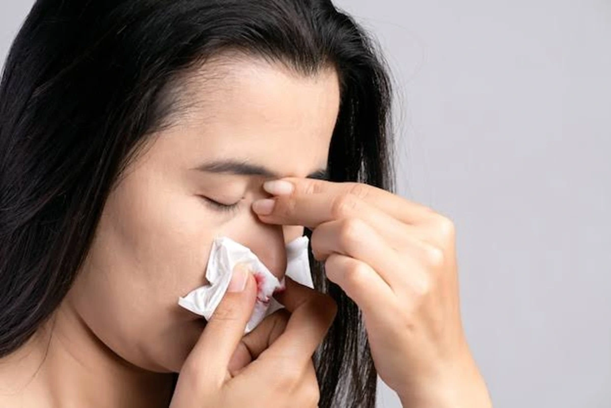 Tips mengatasi mimisan dengan menekan hidung secara pelan menggunakan tisu.(freepik)