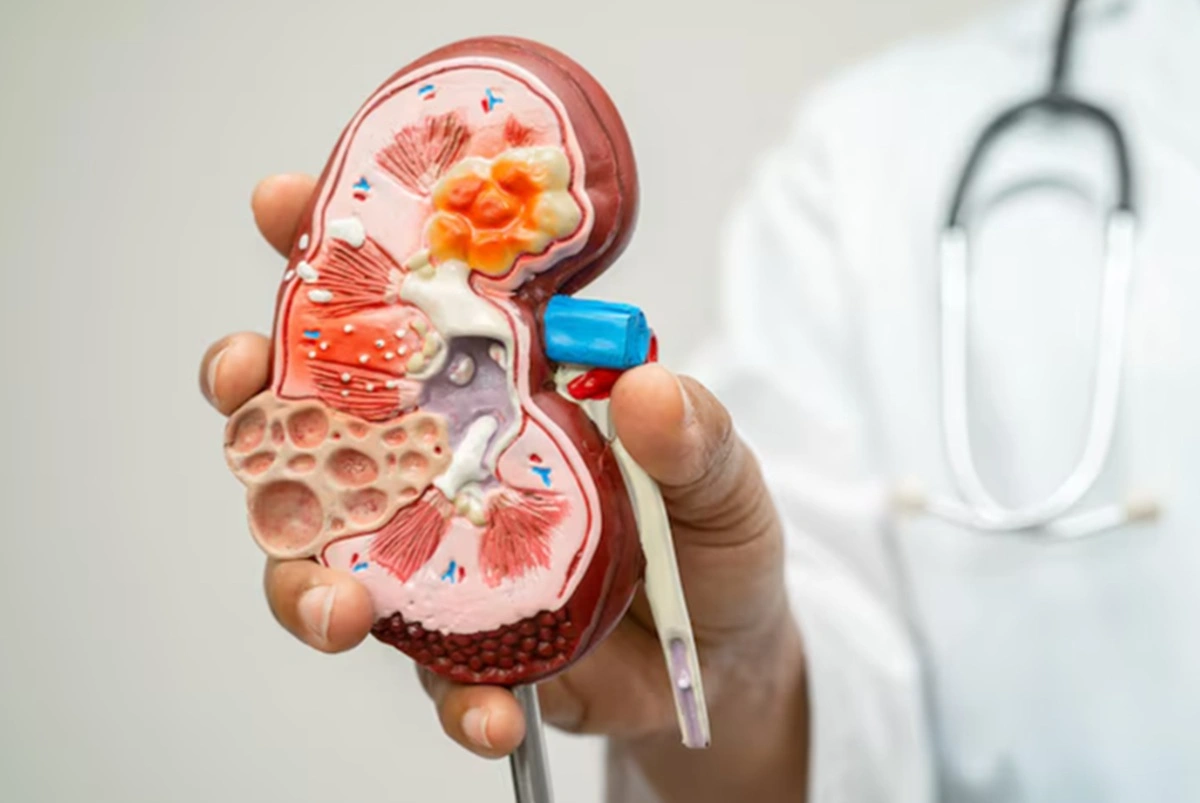 Deteksi Dini Jaga Kesehatan Ginjal, Perhatikan Warna Urine Keruh